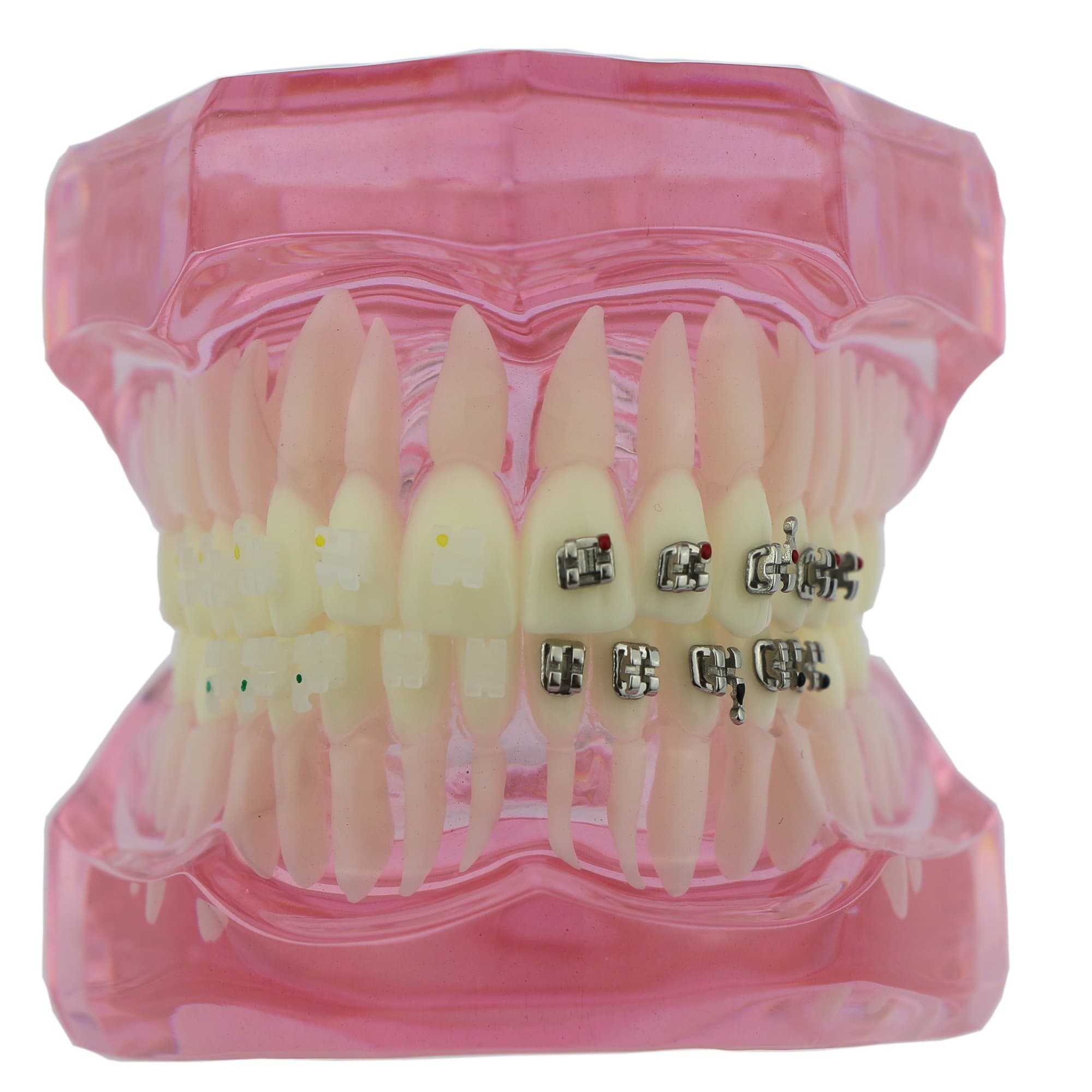 Dental Orthodontics Study Model with Ceramic and Metal Brackets 3003P